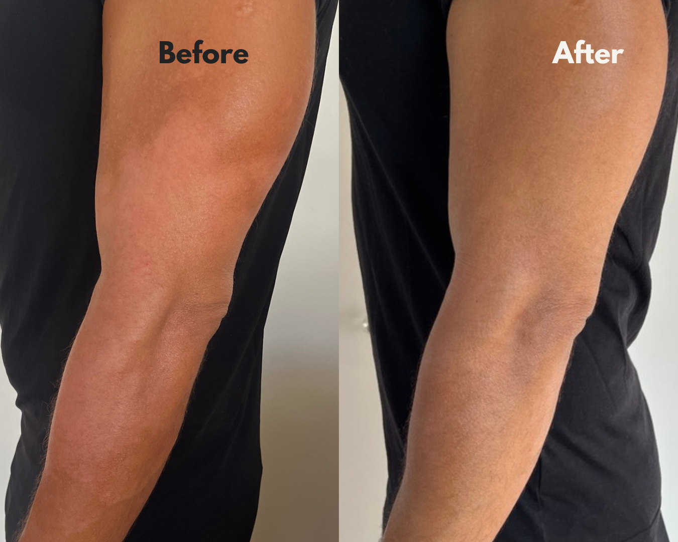 Before and after using MOKA — left arm
