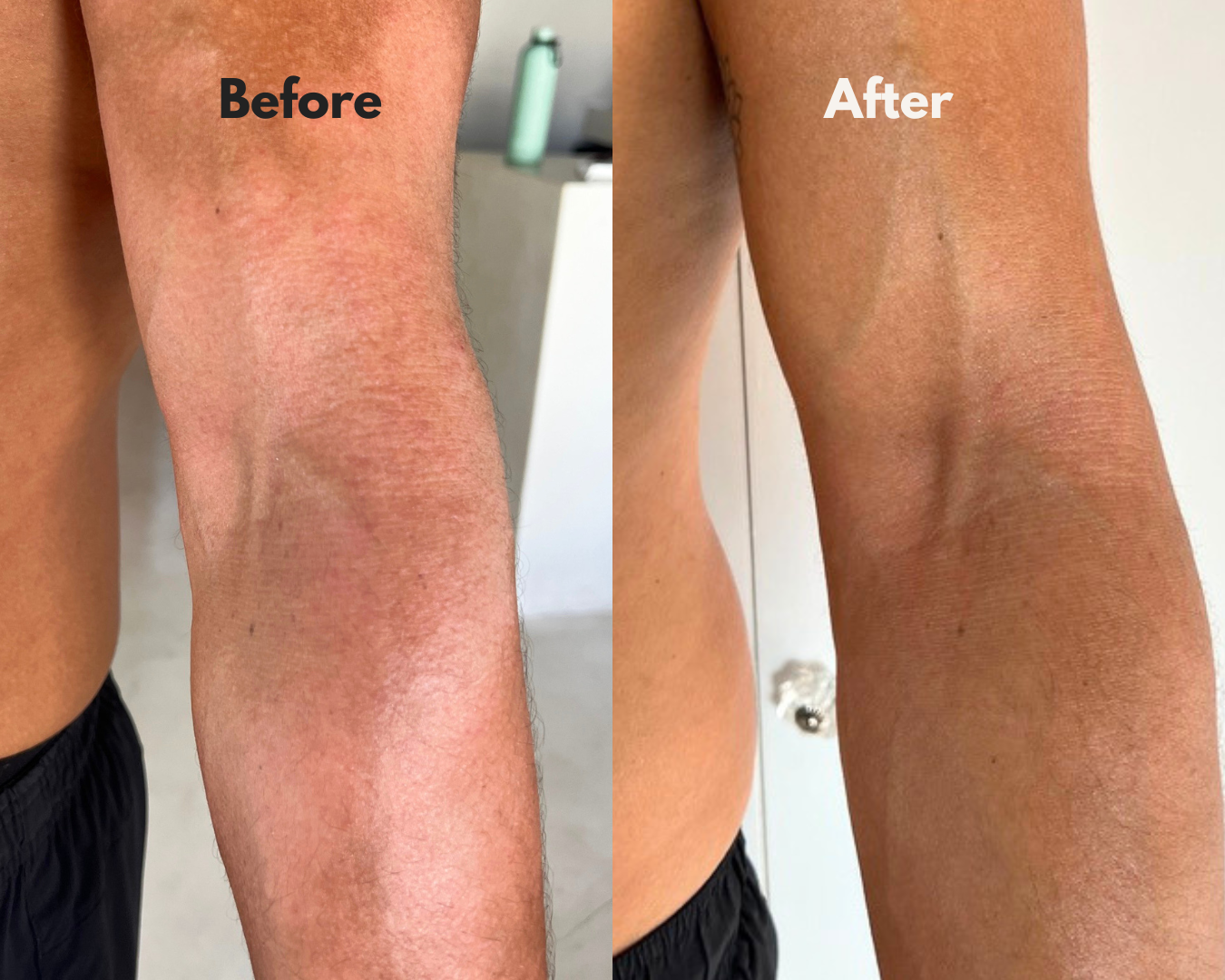 Before and after using MOKA — left inner elbow
