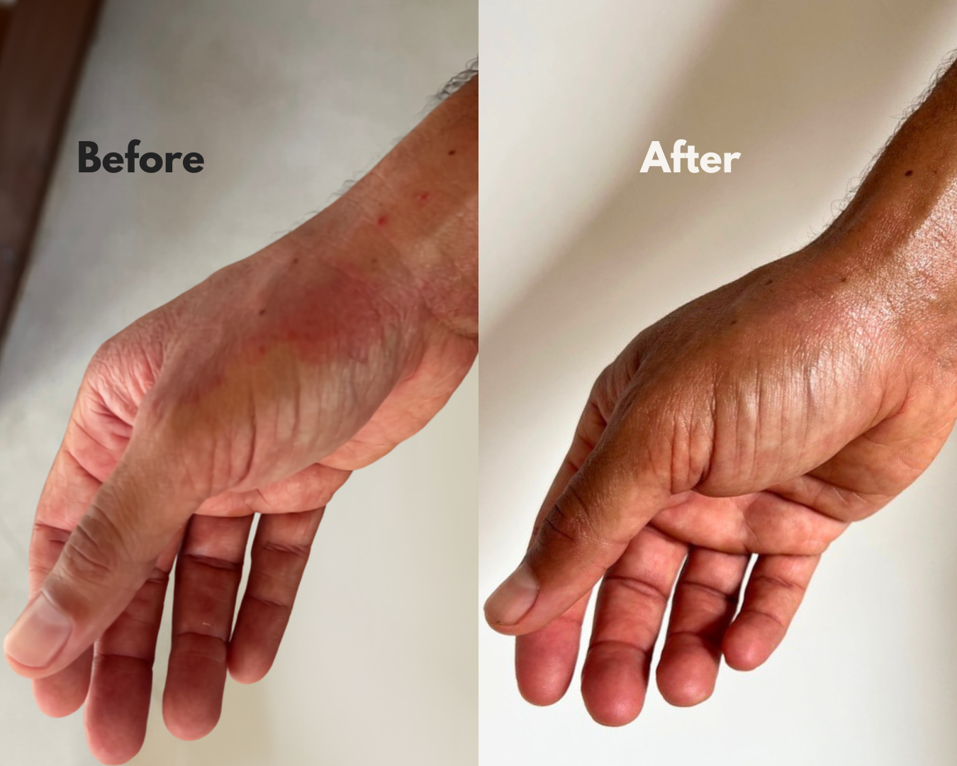 Before and after using MOKA — right wrist