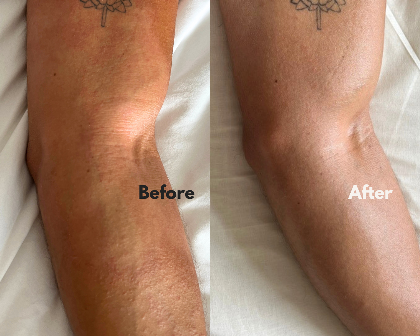 Before and after using MOKA — left inner arm