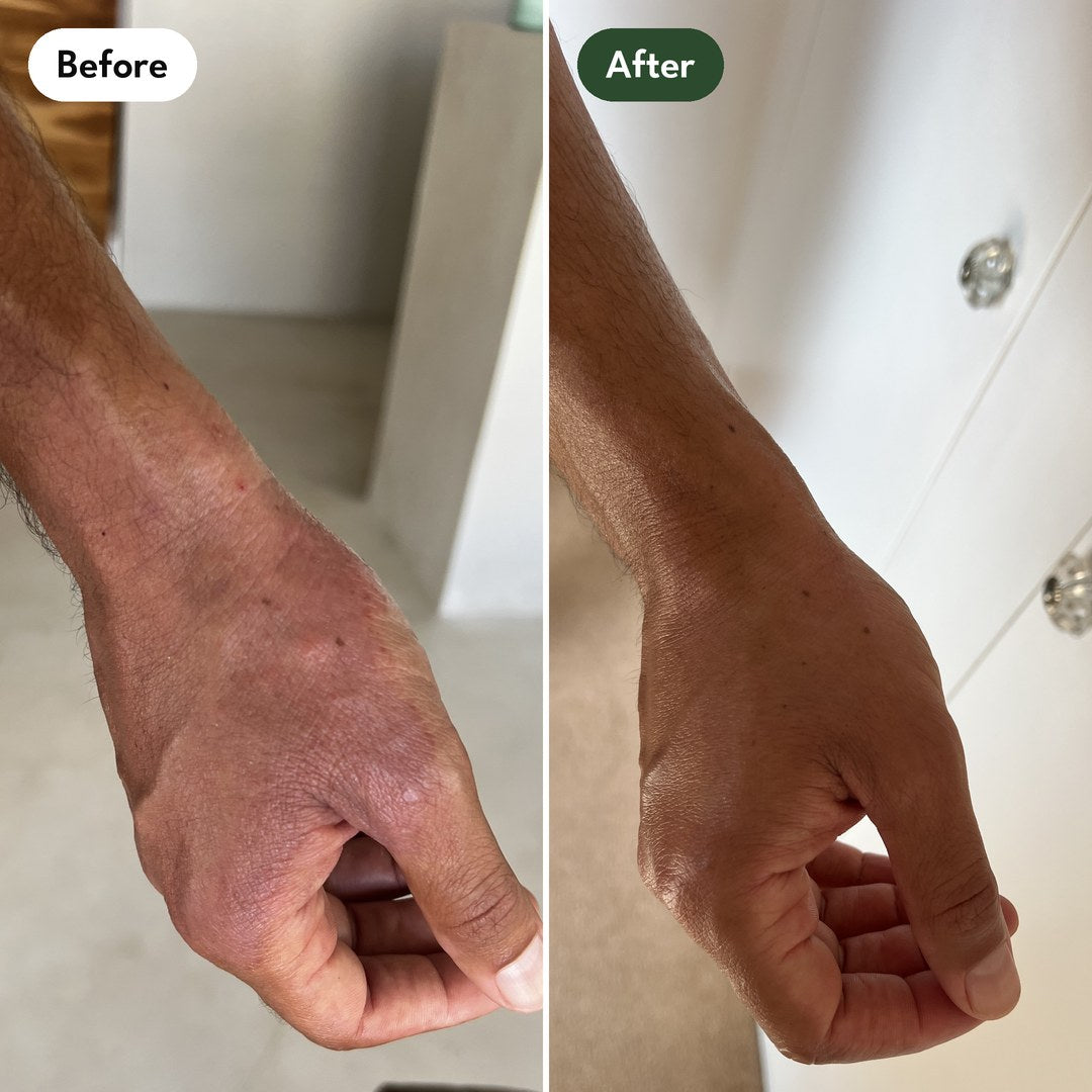 Josh's right hand, clenched: before and after