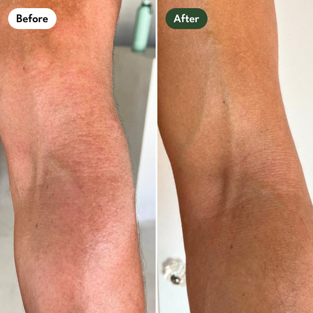 Josh's left inner elbow: before and after