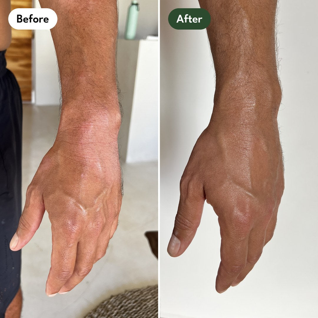 Josh's left wrist and hand: before and after