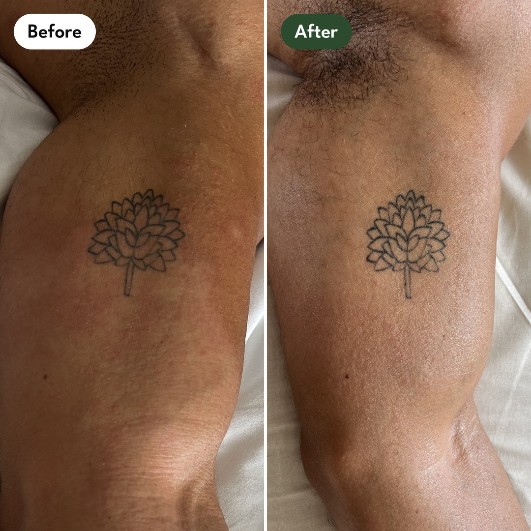 Josh's left inner arm by his tattoo: before and after