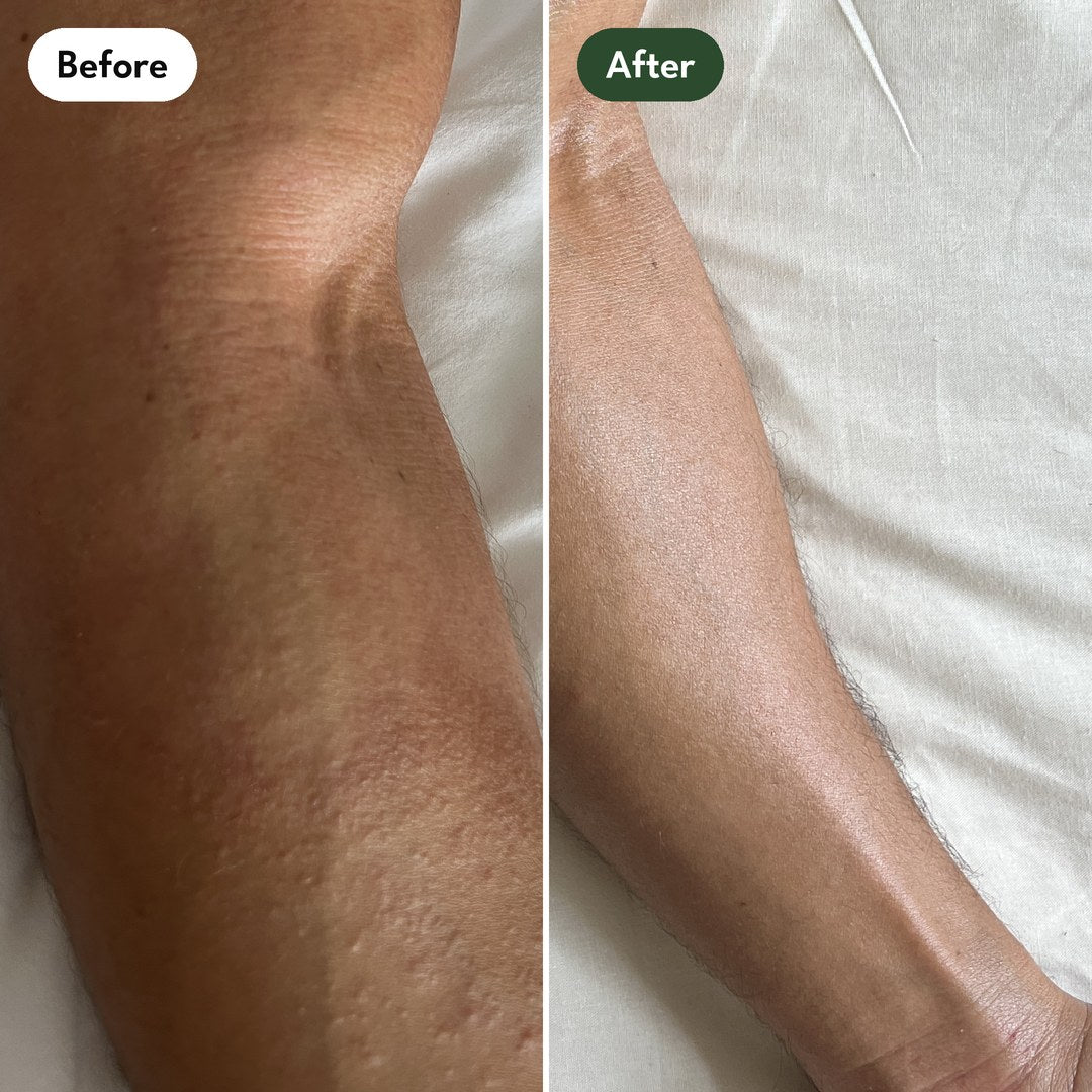 Josh's left forearm towards the wrist: before and after